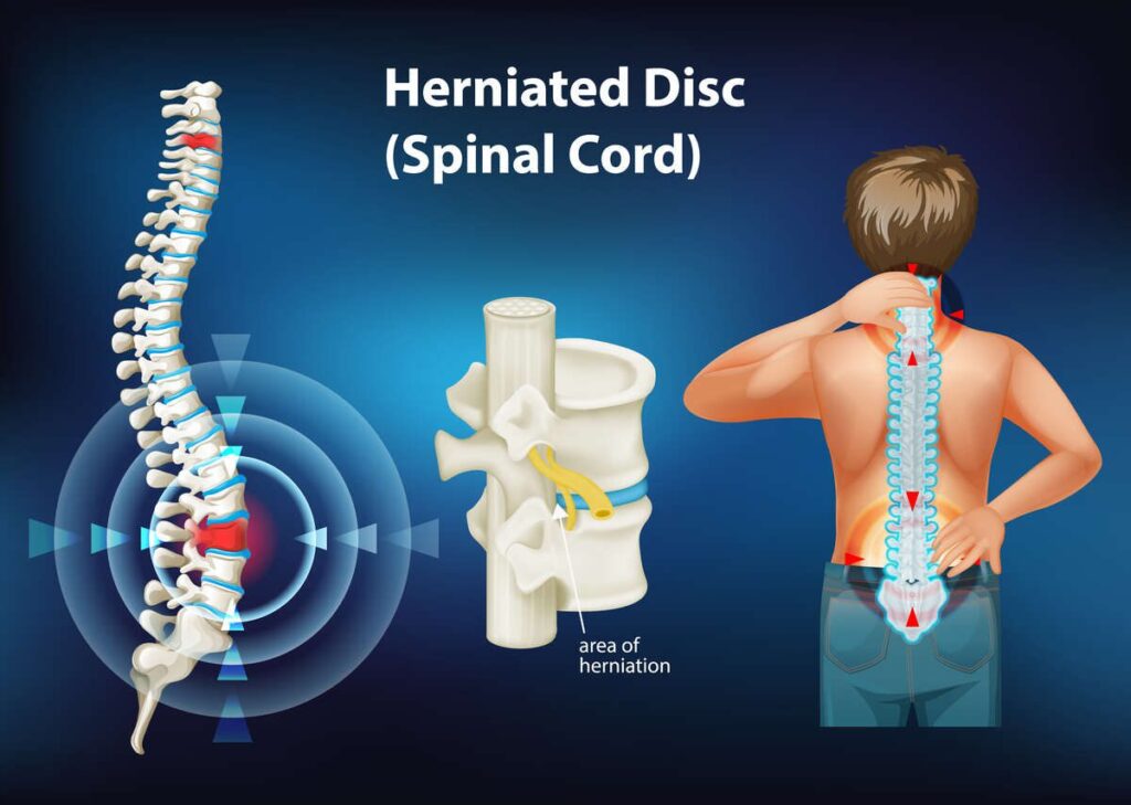 Diagram showing herniated disc